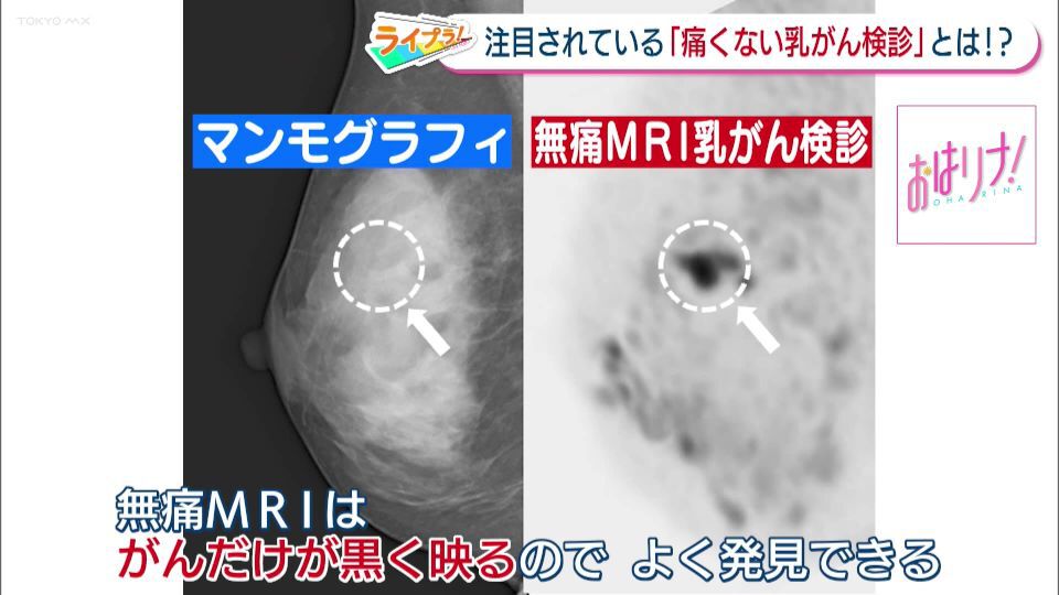 9人に1人がかかるものの検診受診率は50％以下…乳がん検診の新た