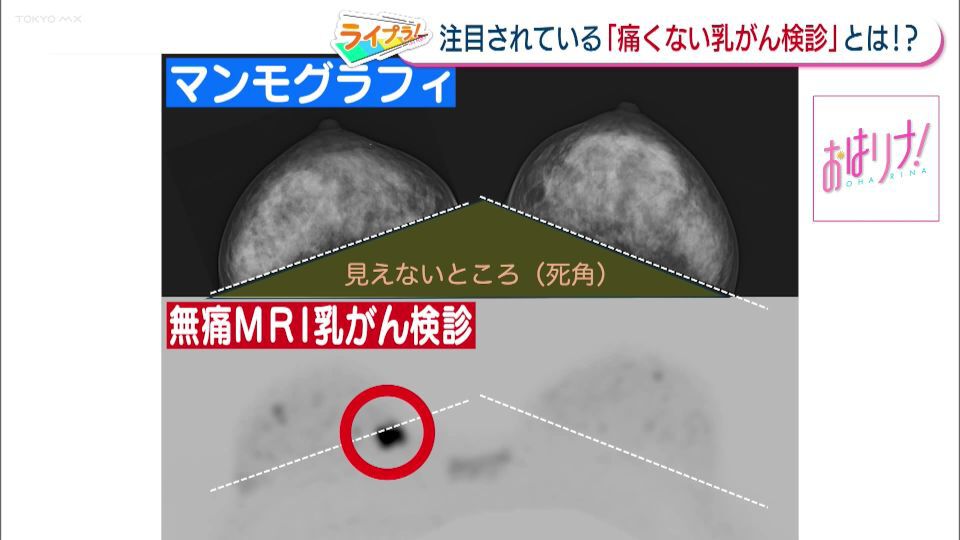 9人に1人がかかるものの検診受診率は50％以下…乳がん検診の新た